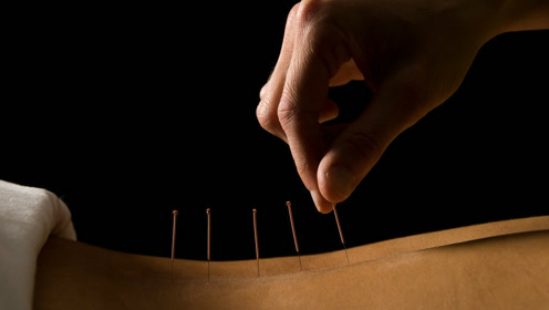 针灸是怎么扎针的