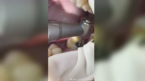 虫牙治疗 腾讯视频