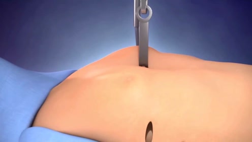 3d医学视频:漏斗胸手术修复
