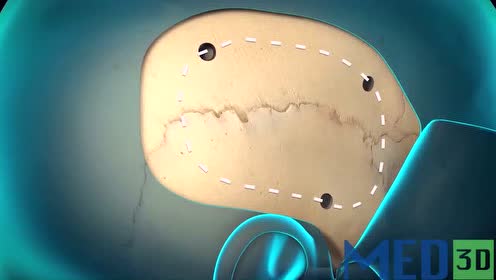 开颅手术演示动画剪辑版