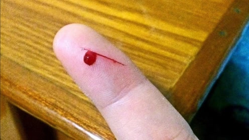 女子手指被纸割伤,以为是小事没放心上,后来却只能截肢保命