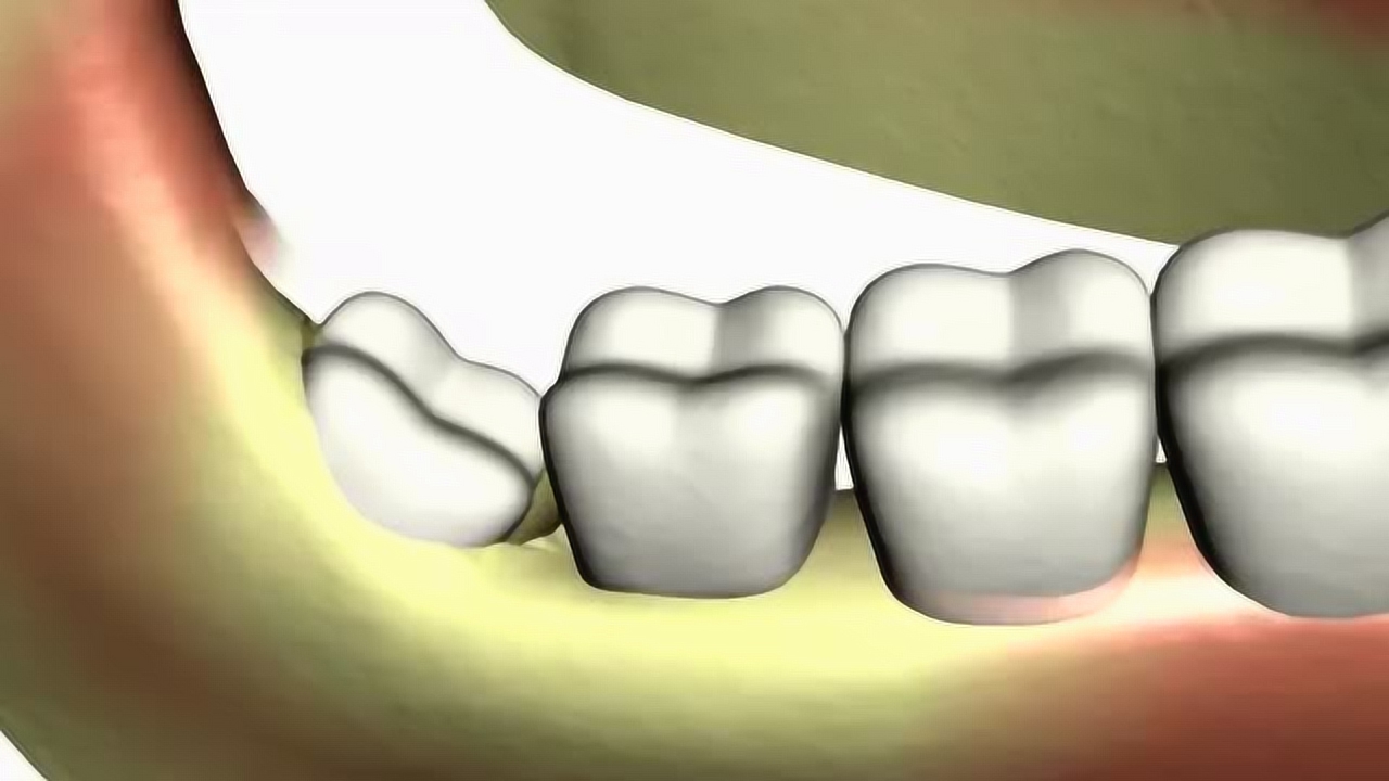 斜着长的智齿是怎么拔的?看完感觉还是不拔的好!
