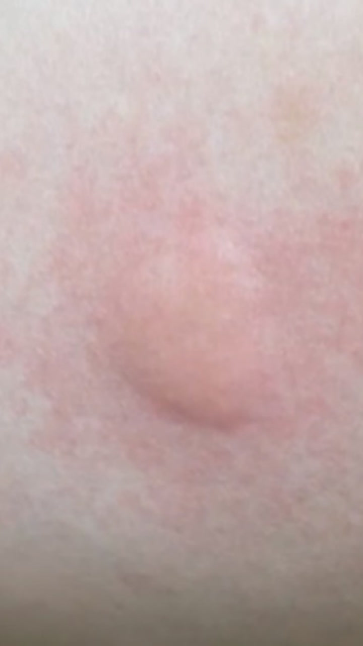 儿时的迷惑行为,被蚊子咬起来的疙瘩,这一操作你做过吗?