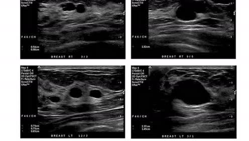 [图]听影像大咖讲：乳腺常见疾病的超声诊断
