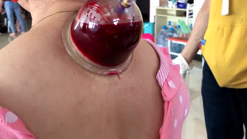 刺血拔罐教学
