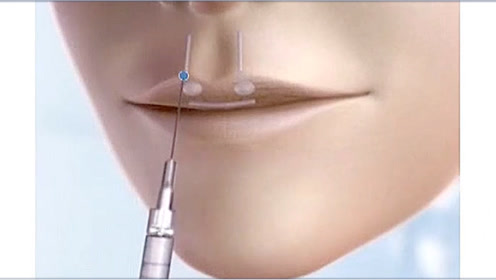 注射玻尿酸丰唇手术过程