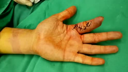 手指再植术后屈肌腱粘连