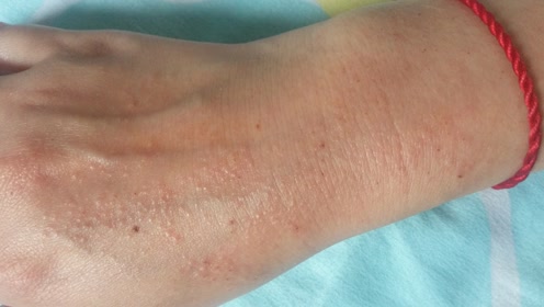 春季皮肤过敏怎么办?先要分清你是荨麻疹还是湿疹,别搞混