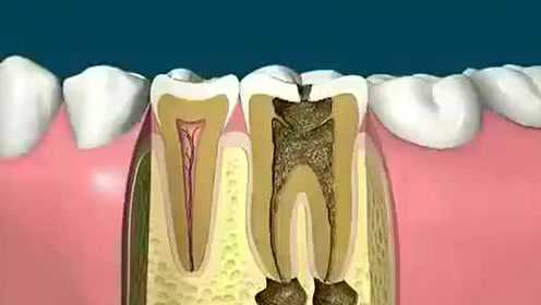 合肥佳冠口腔:根管治疗主要针对牙齿内部,是治疗急性牙髓炎最有效的