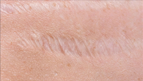 多年老疤痕还能去掉吗?该怎么消除?听皮肤科大夫怎么说