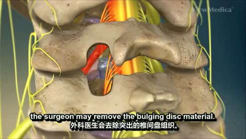 颈椎管扩大成形术 腾讯视频