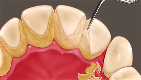 一部超解压视频,记得要保护好你的牙齿,解压短片《清理牙结石》