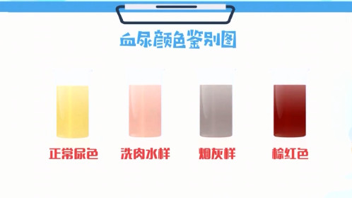 《名医话养生》看得到红色的才是血尿吗？_综艺_高清完整版视频在线观看_腾讯视频