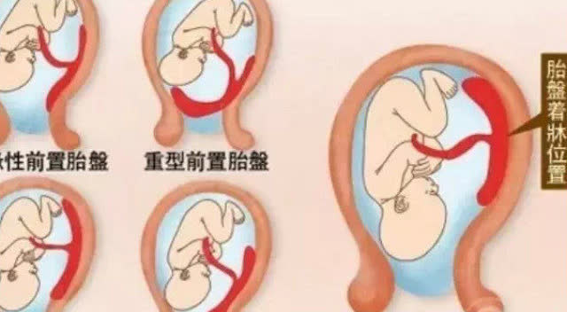 孕妇低置胎盘该怎么办?