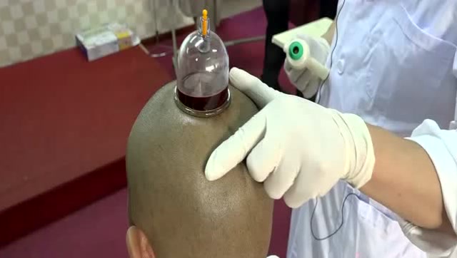 王合民——百会放血治疗多种疾病