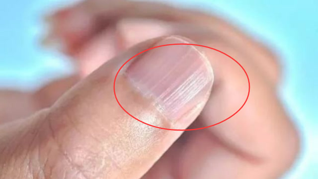 52岁阿姨查出肝癌,只要指甲上出现这东西,癌症就离你不远了