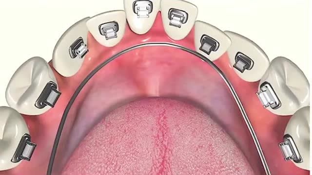 难怪明星的牙齿那么好看,原来做了舌侧矫正,刚看到一半就想去医院!