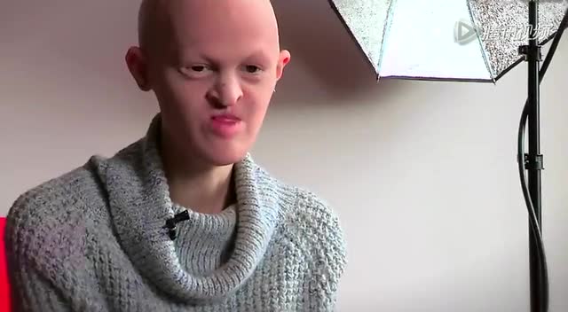 美国女模身患罕见遗传病 光头没牙展示别样美