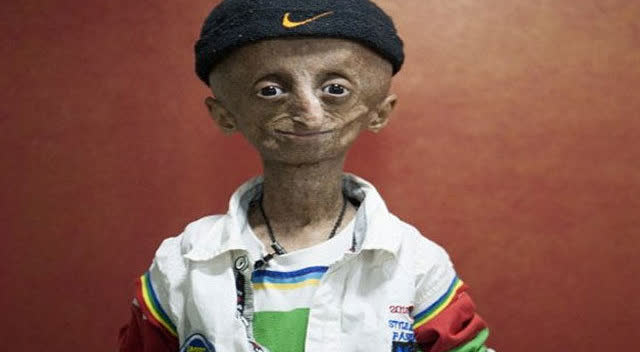 10大基因突变的真实人类