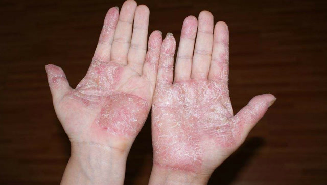 手脚干裂蜕皮太难受,涂点这个,让你的皮肤光滑白嫩,医生都说好!