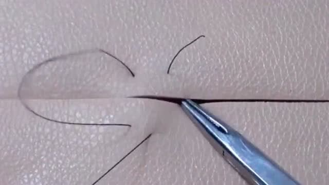 医生必学的内八缝合手法,这样缝针不留疤,而且还能减少对伤口的伤害度