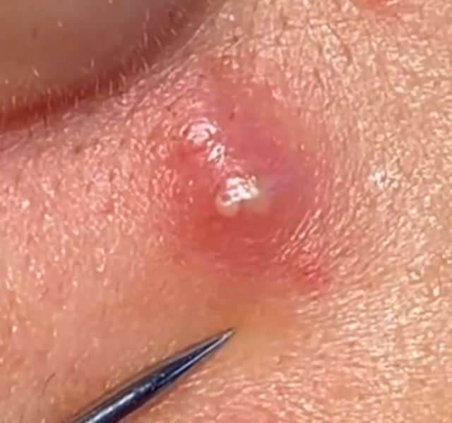脸上的脓包怎么处理真想一针戳下去直接爆浆