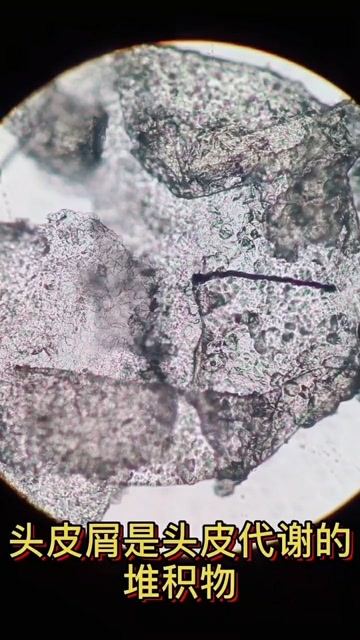 显微镜下的头皮屑图片