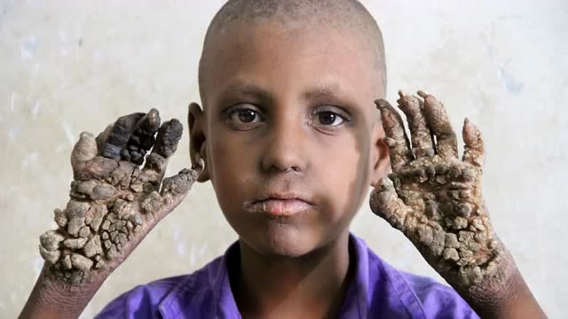 实拍孟加拉7岁男孩患怪病变"树人" 手脚长厚疣似树皮