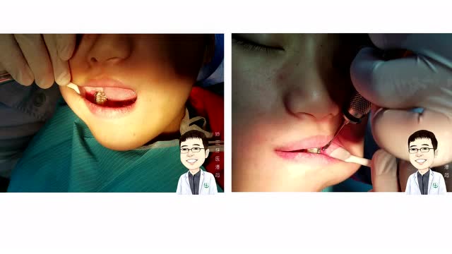 下颌外斜线支抗钉的植入