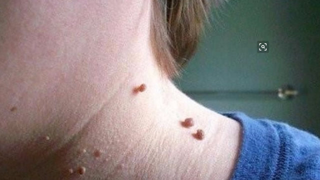 身上长了瘊子不用怕滴一滴它15天轻松告别烦人小肉粒