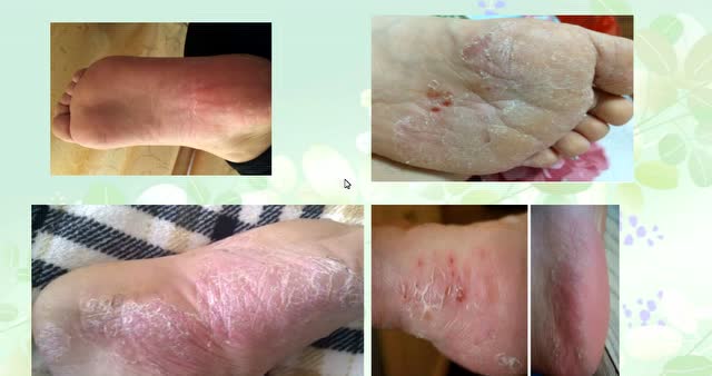 脚臭,脚痒,脚烂,路边买了一种菜,5天脚气断根永不复发!