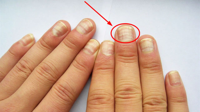 正常的指甲纹路图图片