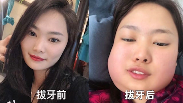女子一次性拔完3颗智齿,第二天起来崩溃了:脸肿得像土拨鼠