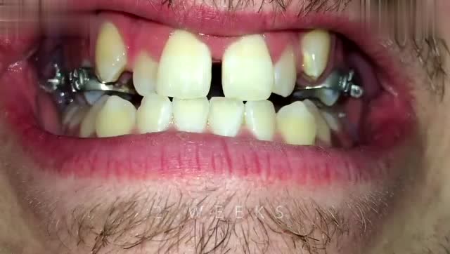 28个月,见证一口牙齿的变化!