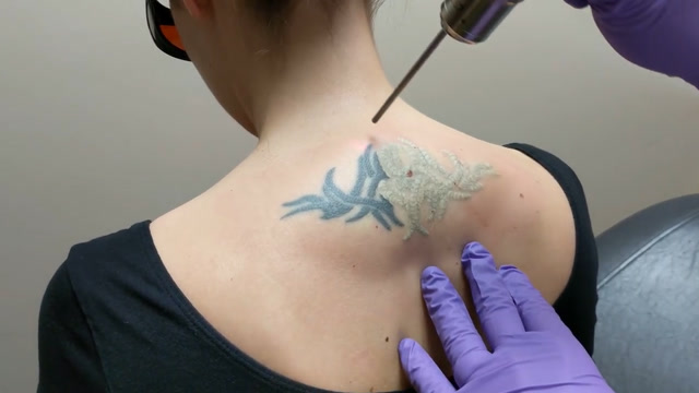 女孩纹身后觉得不好看,用激光去除纹身,看着都疼