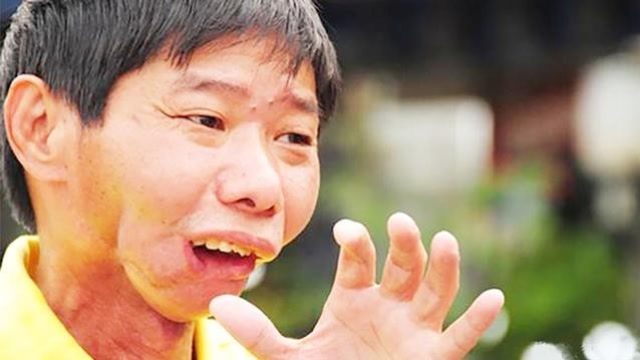 连续吃5年槟榔,身体会发生什么变化?湖南小伙被割了半张脸