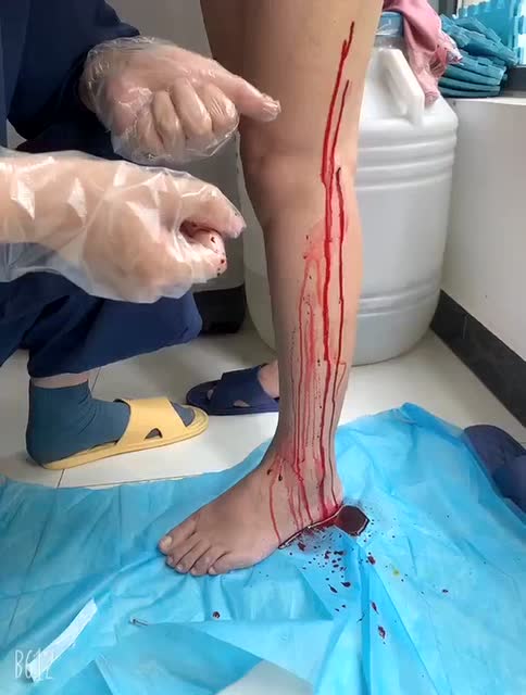 程氏刺血疗法之腿部胆经刺血