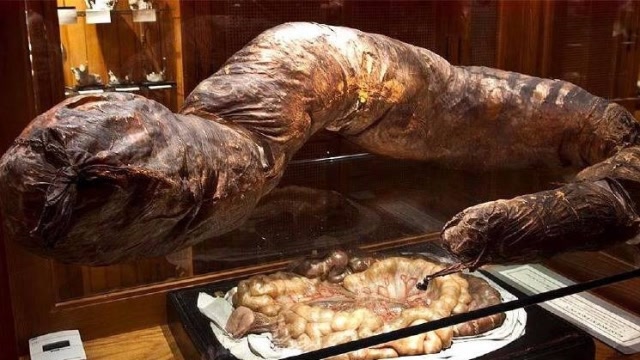 三年未排便,成为第一个被"屎"憋死的男人,大肠竟被展览