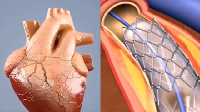 心脏支架从1.3万降至700元左右,看视频演示心脏支架安装手术