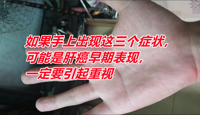 如果手上出现这三个症状,可能是肝癌早期表现,一定要引起重视