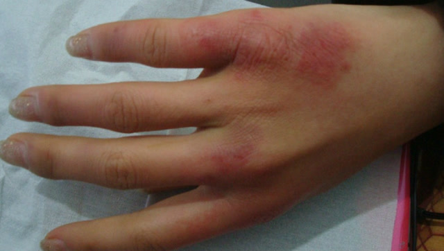 手脚冻疮又痒又痛,教你3招,缓解冻疮疼痛不留疤!