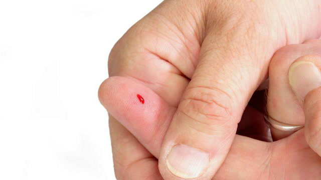 手指扎刺不用针挑,教你一个小技巧,不用受疼,手上的刺自己跑出来