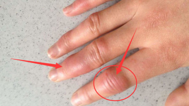 肝癌手指的变化图片图片