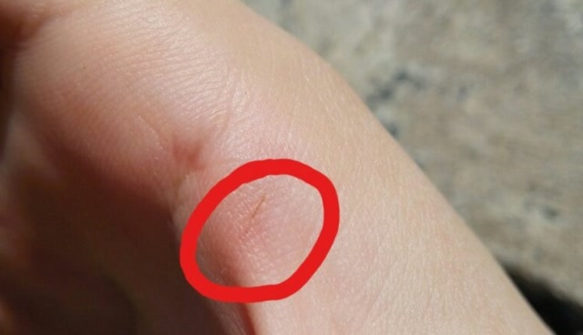 木刺扎到手上出不来?别用针挑了,两个小妙招让木刺自己跑出来!