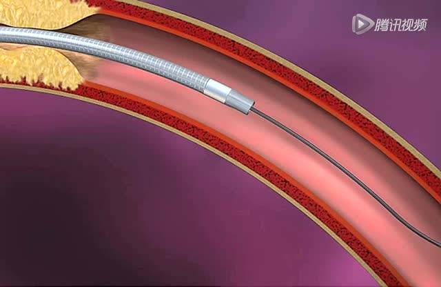 wingspan支架植入动画示范