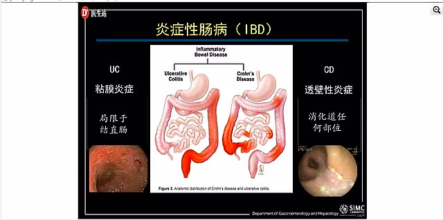 20151020炎症性肠病的内镜诊断和评估