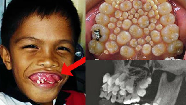 男孩嘴里面长了300颗牙齿,看一眼头皮发麻!