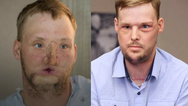 美国成功实行首例换脸手术,持续十小时,手术前没人敢看!