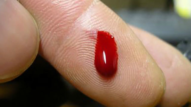 手指割破流血了,放嘴里吸一吸真能杀菌吗?听听专家怎么说