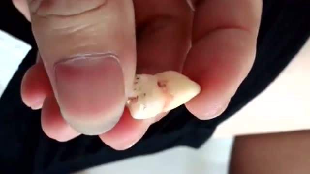 拔下来的智齿牙根太长了